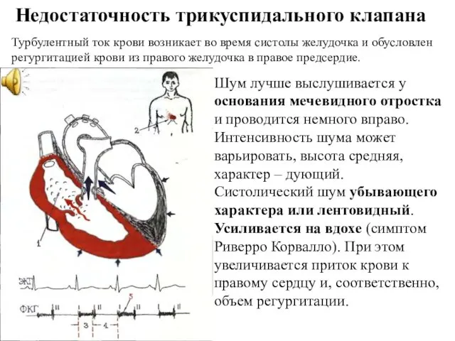 Недостаточность трикуспидального клапана Турбулентный ток крови возникает во время систолы желудочка