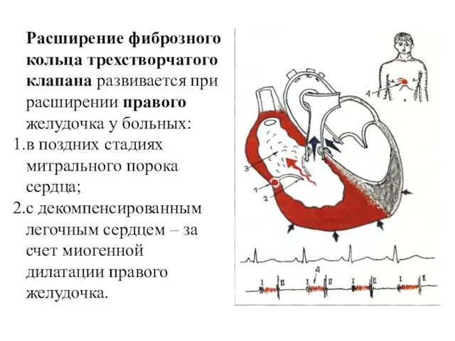 Расширение фиброзного кольца трехстворчатого клапана развивается при расширении правого желудочка у