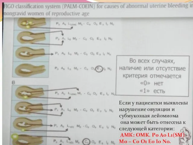 Если у пациентки выявлены нарушение овуляции и субмукозная лейомиома она может