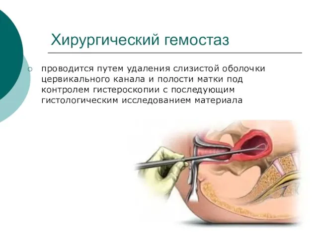 Хирургический гемостаз проводится путем удаления слизистой оболочки цервикального канала и полости