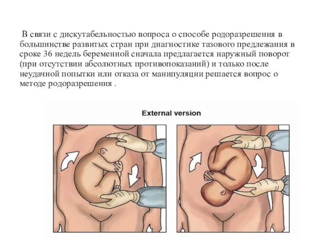 В связи с дискутабельностью вопроса о способе родоразрешения в большинстве развитых