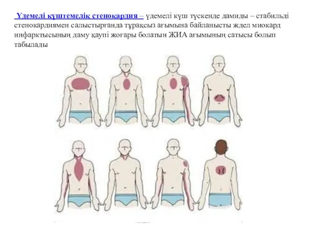 Үдемелі күштемелік стенокардия – үдемелі күш түскенде дамиды – стабильді стенокардиямен