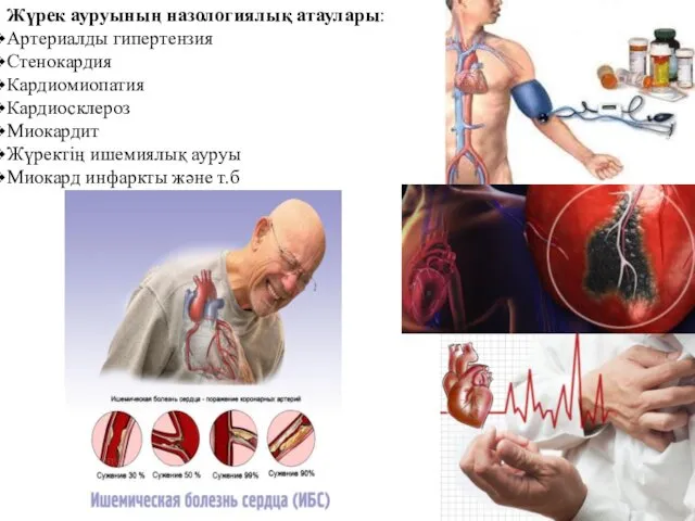 Жүрек ауруының назологиялық атаулары: Артериалды гипертензия Стенокардия Кардиомиопатия Кардиосклероз Миокардит Жүректің