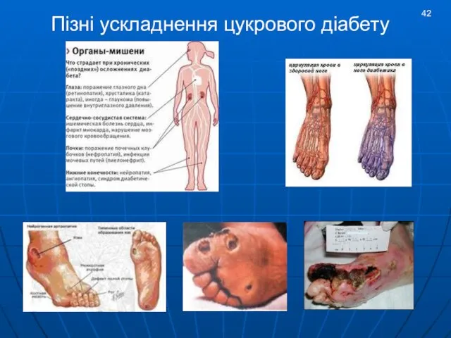 Пізні ускладнення цукрового діабету