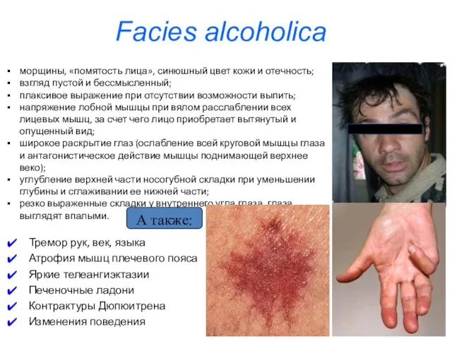 Facies alcoholica морщины, «помятость лица», синюшный цвет кожи и отечность; взгляд