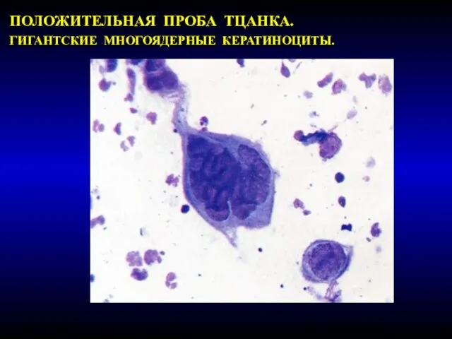 ПОЛОЖИТЕЛЬНАЯ ПРОБА ТЦАНКА. ГИГАНТСКИЕ МНОГОЯДЕРНЫЕ КЕРАТИНОЦИТЫ.