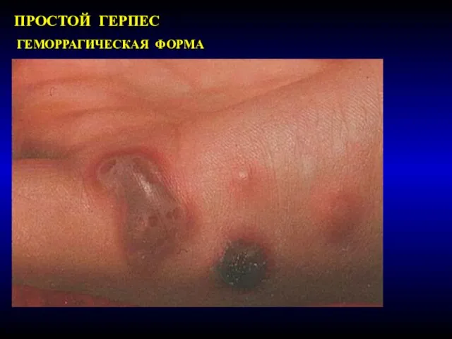 ПРОСТОЙ ГЕРПЕС ГЕМОРРАГИЧЕСКАЯ ФОРМА