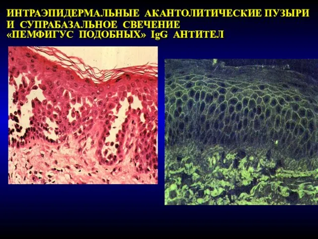ИНТРАЭПИДЕРМАЛЬНЫЕ АКАНТОЛИТИЧЕСКИЕ ПУЗЫРИ И СУПРАБАЗАЛЬНОЕ СВЕЧЕНИЕ «ПЕМФИГУС ПОДОБНЫХ» IgG АНТИТЕЛ