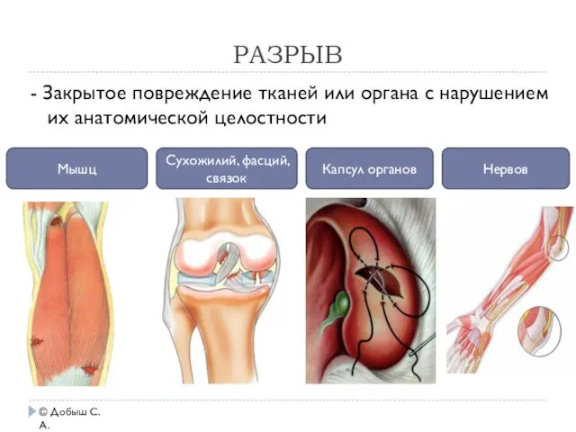 РАЗРЫВ © Добыш С.А. - Закрытое повреждение тканей или органа с