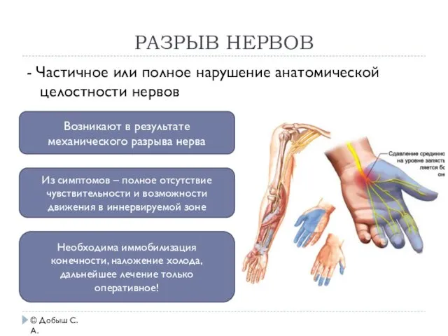 РАЗРЫВ НЕРВОВ Возникают в результате механического разрыва нерва Из симптомов –