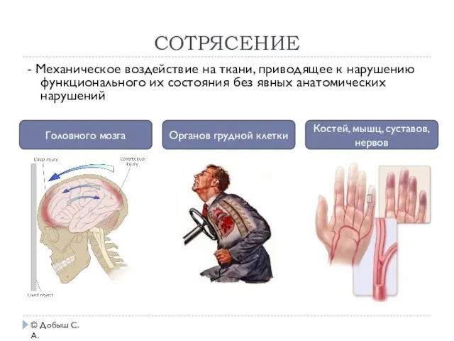 СОТРЯСЕНИЕ © Добыш С.А. - Механическое воздействие на ткани, приводящее к