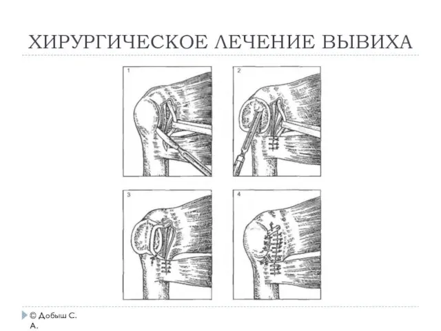 ХИРУРГИЧЕСКОЕ ЛЕЧЕНИЕ ВЫВИХА © Добыш С.А.