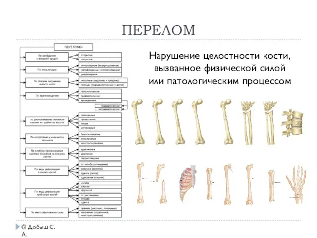 ПЕРЕЛОМ © Добыш С.А. Нарушение целостности кости, вызванное физической силой или патологическим процессом