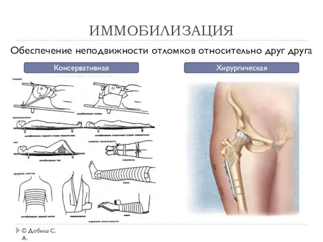 ИММОБИЛИЗАЦИЯ © Добыш С.А. Обеспечение неподвижности отломков относительно друг друга Консервативная Хирургическая