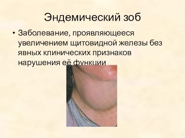 Эндемический зоб Заболевание, проявляющееся увеличением щитовидной железы без явных клинических признаков нарушения её функции