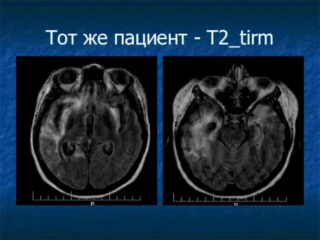 Тот же пациент - Т2_tirm