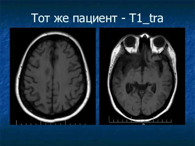 Тот же пациент - Т1_tra