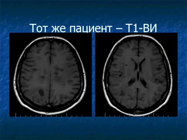 Тот же пациент – Т1-ВИ