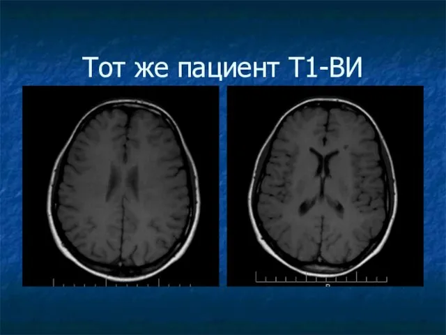 Тот же пациент Т1-ВИ