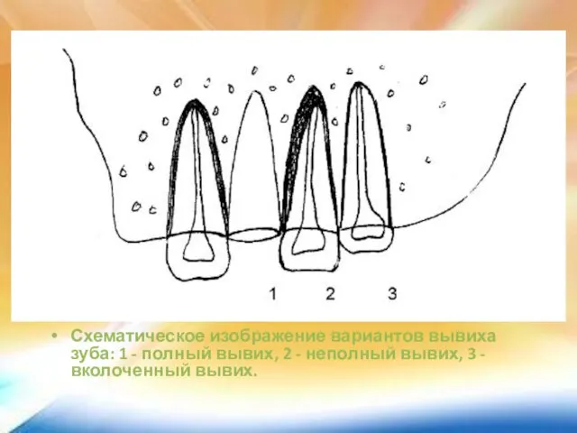 Схематическое изображение вариантов вывиха зуба: 1 - полный вывих, 2 -