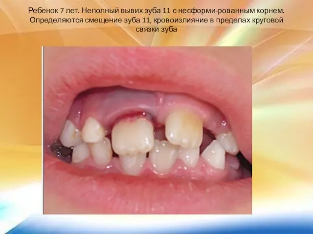 Ребенок 7 лет. Неполный вывих зуба 11 с несформи-рованным корнем. Определяются