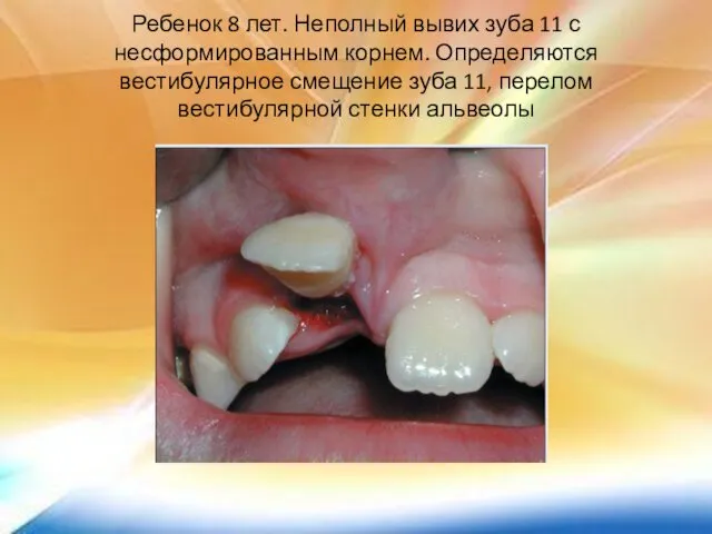 Ребенок 8 лет. Неполный вывих зуба 11 с несформированным корнем. Определяются