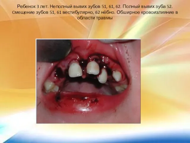 Ребенок 3 лет. Неполный вывих зубов 51, 61, 62. Полный вывих