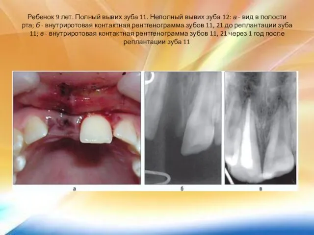 Ребенок 9 лет. Полный вывих зуба 11. Неполный вывих зуба 12: