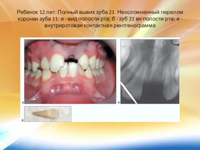 Ребенок 12 лет. Полный вывих зуба 21. Неосложненный перелом коронки зуба