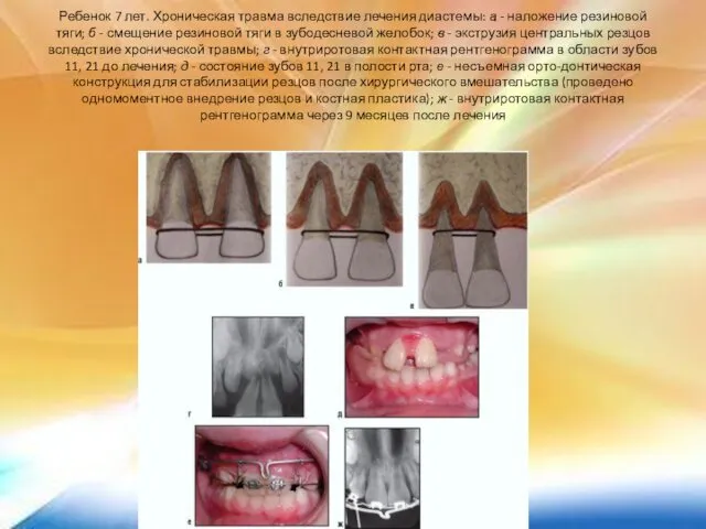 Ребенок 7 лет. Хроническая травма вследствие лечения диастемы: а - наложение
