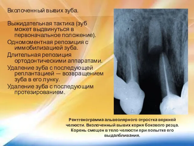 Рентгенограмма альвеолярного отростка верхней челюсти. Вколоченный вывих корня бокового резца. Корень