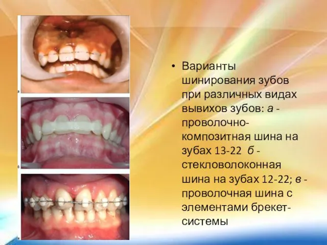 Варианты шинирования зубов при различных видах вывихов зубов: а - проволочно-композитная