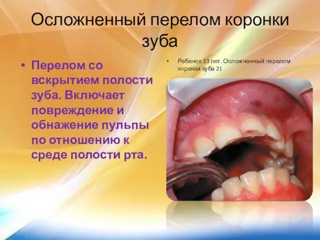 Осложненный перелом коронки зуба Перелом со вскрытием полости зуба. Включает повреждение