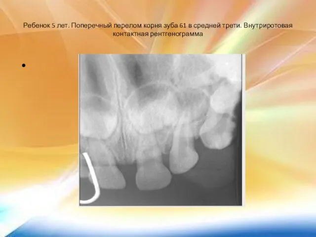 Ребенок 5 лет. Поперечный перелом корня зуба 61 в средней трети. Внутриротовая контактная рентгенограмма