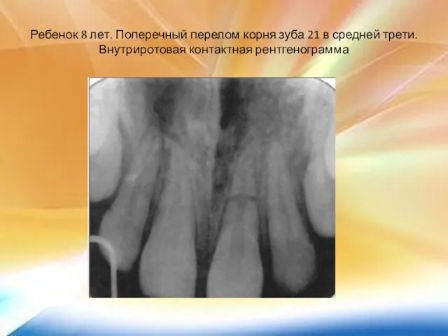 Ребенок 8 лет. Поперечный перелом корня зуба 21 в средней трети. Внутриротовая контактная рентгенограмма