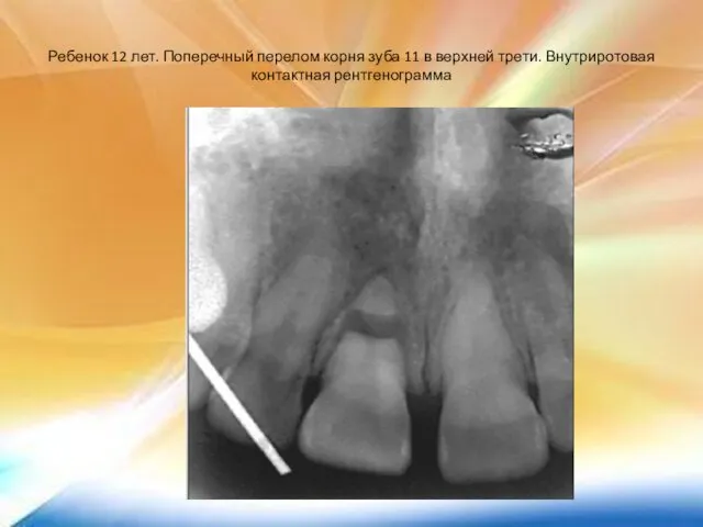 Ребенок 12 лет. Поперечный перелом корня зуба 11 в верхней трети. Внутриротовая контактная рентгенограмма