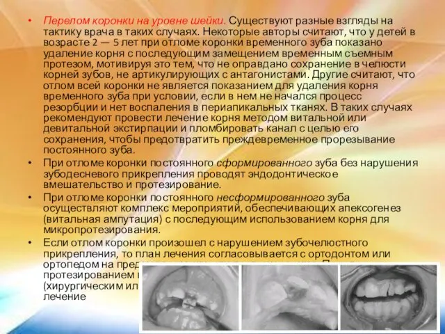 Перелом коронки на уровне шейки. Существуют разные взгляды на тактику врача