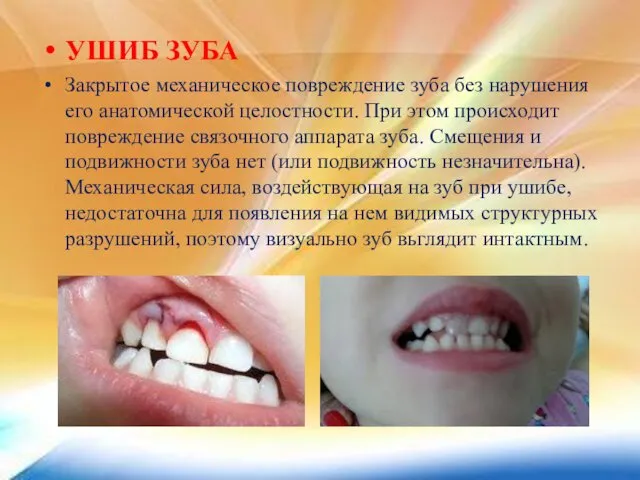 УШИБ ЗУБА Закрытое механическое повреждение зуба без нарушения его анатомической целостности.