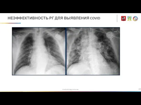 medradiology.moscow НЕЭФФЕКТИВНОСТЬ РГ ДЛЯ ВЫЯВЛЕНИЯ COVID