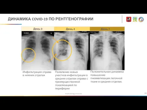 medradiology.moscow ДИНАМИКА COVID-19 ПО РЕНТГЕНОГРАФИИ День 0 День 4 День 7