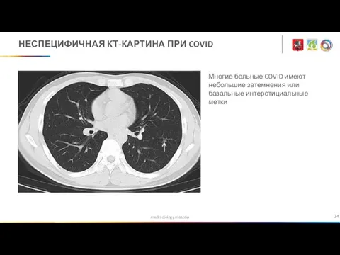 medradiology.moscow НЕСПЕЦИФИЧНАЯ КТ-КАРТИНА ПРИ COVID Многие больные COVID имеют небольшие затемнения или базальные интерстициальные метки