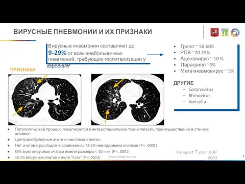 medradiology.moscow ВИРУСНЫЕ ПНЕВМОНИИ И ИХ ПРИЗНАКИ Патологический процесс локализуется в интерстициальной