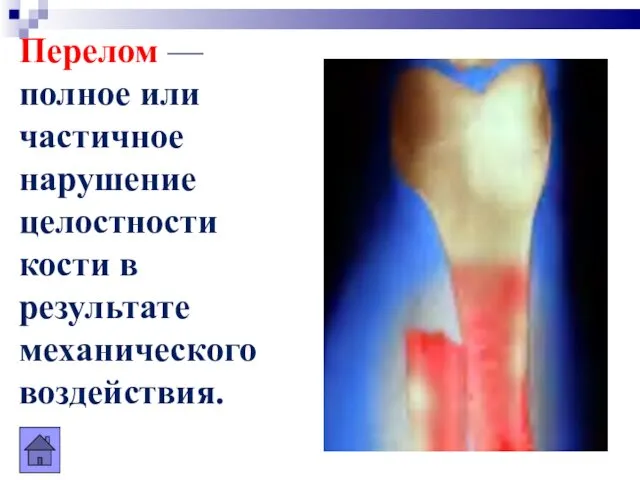 Перелом — полное или частичное нарушение целостности кости в результате механического воздействия.