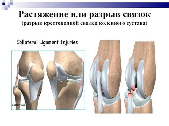 Растяжение или разрыв связок (разрыв крестовидной связки коленного сустава)