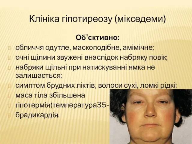 Клініка гіпотиреозу (мікседеми) Об'єктивно: обличчя одутле, маскоподібне, амімічне; очні щілини звужені