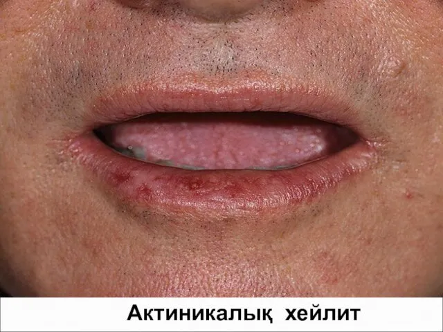 Актиникалық хейлит