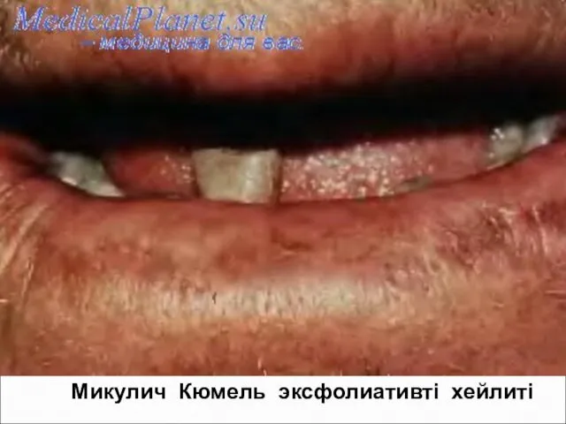 Микулич Кюмель эксфолиативті хейлиті