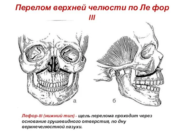 Перелом верхней челюсти по Ле фор III Лефор-III (нижний тип) -