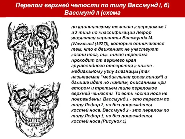 Перелом верхней челюсти по типу Вассмунд I, б) Вассмунд II (схема