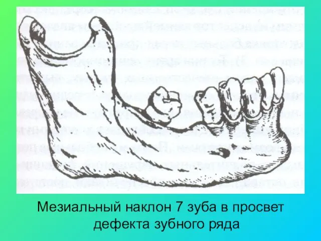 Мезиальный наклон 7 зуба в просвет дефекта зубного ряда